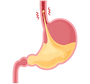 胃酸が食道に流れてくる逆流性食道炎