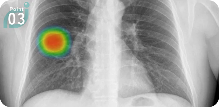 AIと医師のダブルチェックで肺疾患を見落とさない