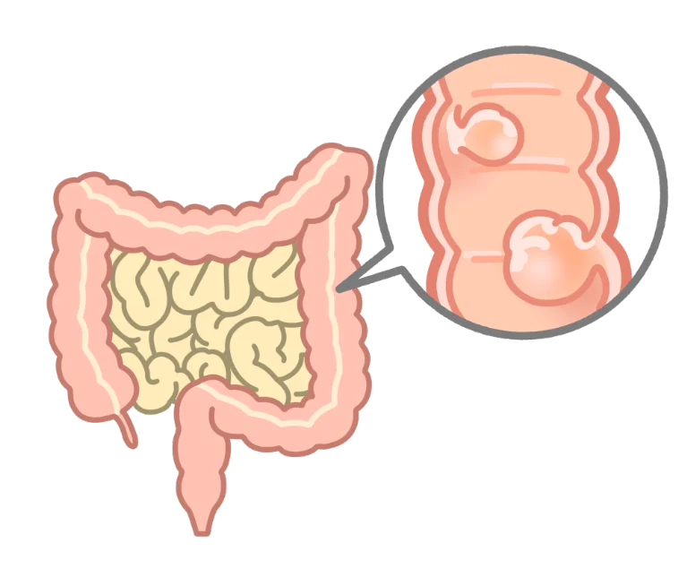 がん化することもある「大腸ポリープ」とは