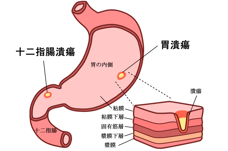 胃酸で粘膜がただれる胃潰瘍・十二指腸潰瘍